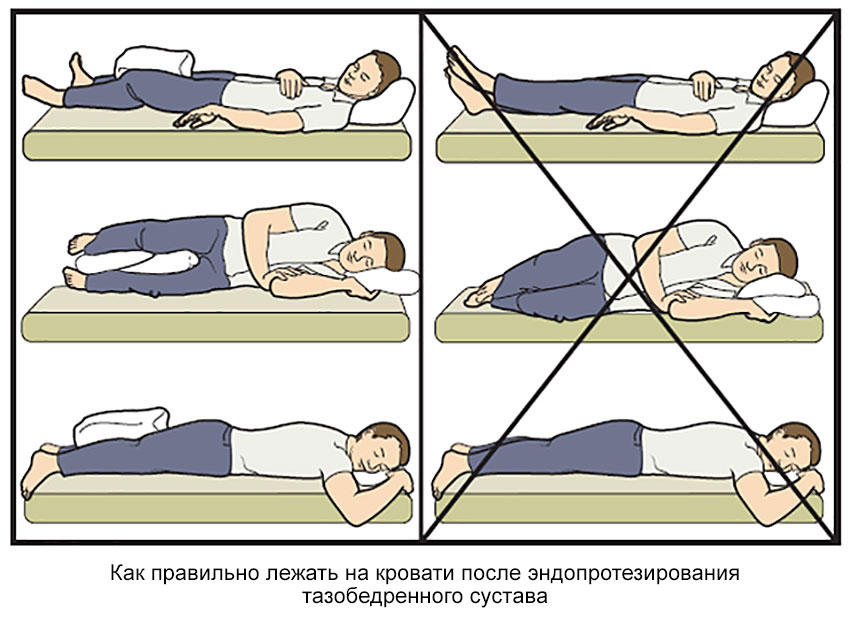 Правильное положение во время сна при реабилитации после протезирования суставов в Москве